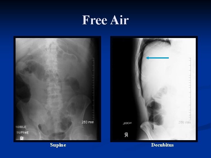 Free Air Supine Decubitus 