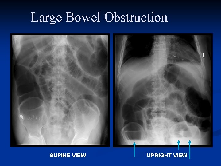 Large Bowel Obstruction SUPINE VIEW UPRIGHT VIEW 