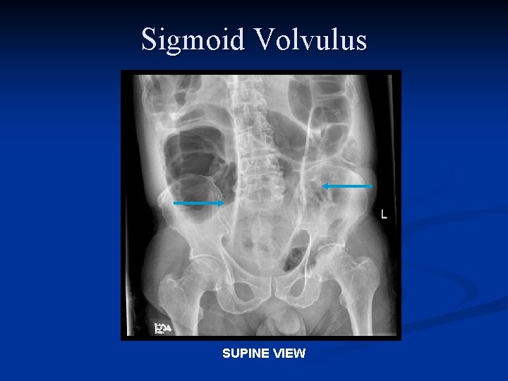 Sigmoid Volvulus SUPINE VIEW 