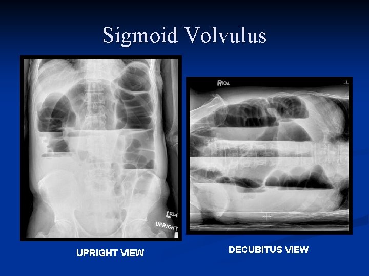 Sigmoid Volvulus UPRIGHT VIEW DECUBITUS VIEW 