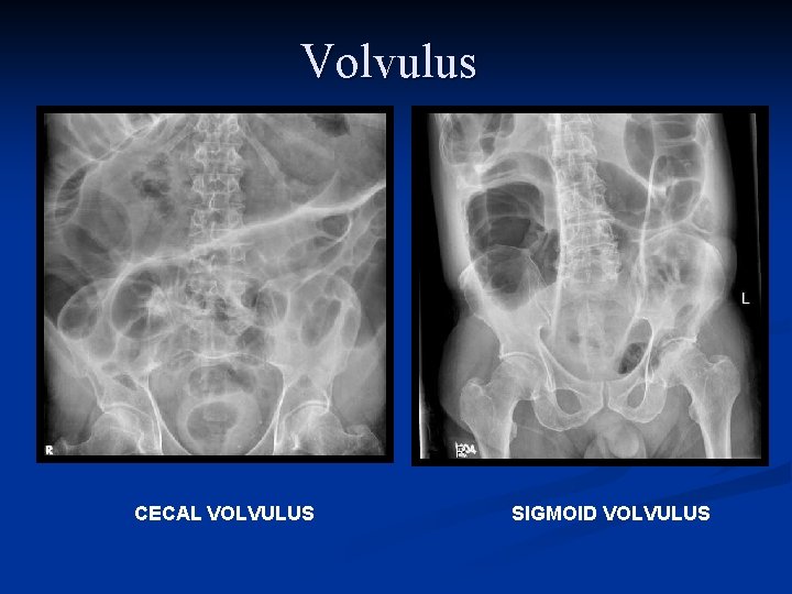Volvulus CECAL VOLVULUS SIGMOID VOLVULUS 