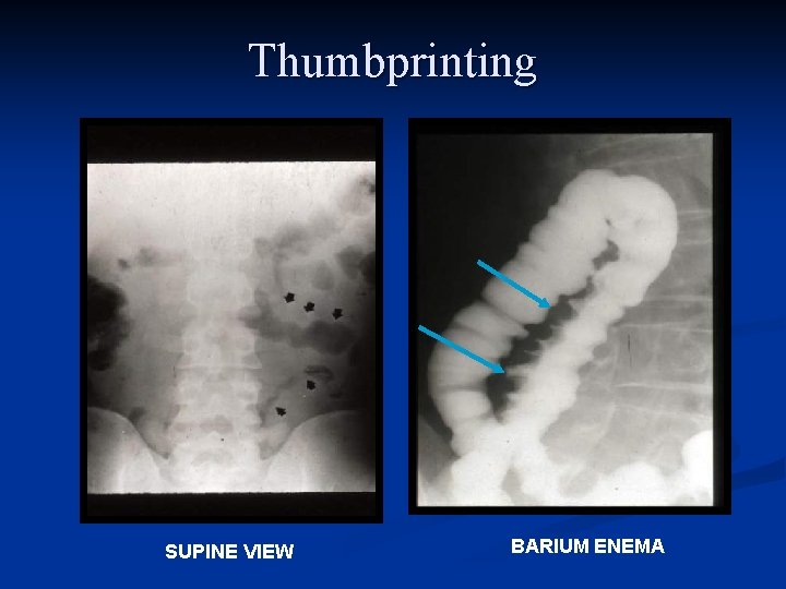 Thumbprinting SUPINE VIEW BARIUM ENEMA 