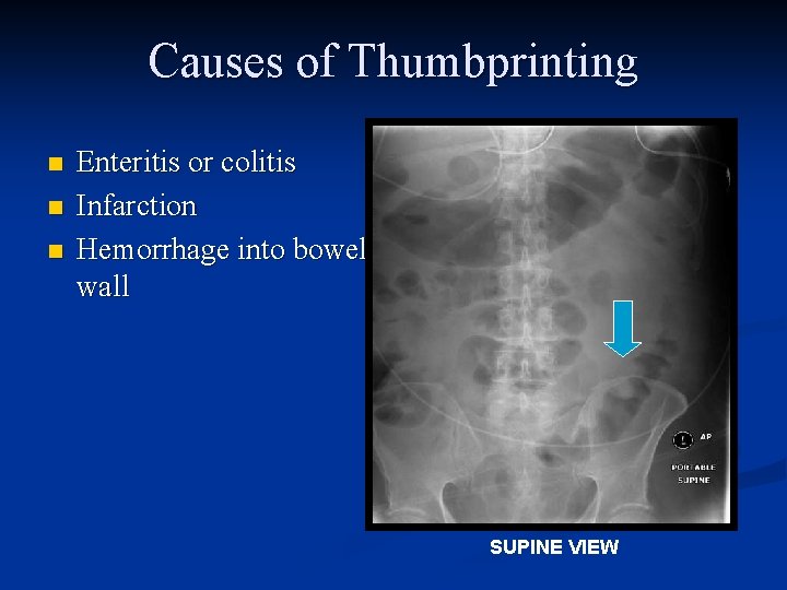 Causes of Thumbprinting n n n Enteritis or colitis Infarction Hemorrhage into bowel wall