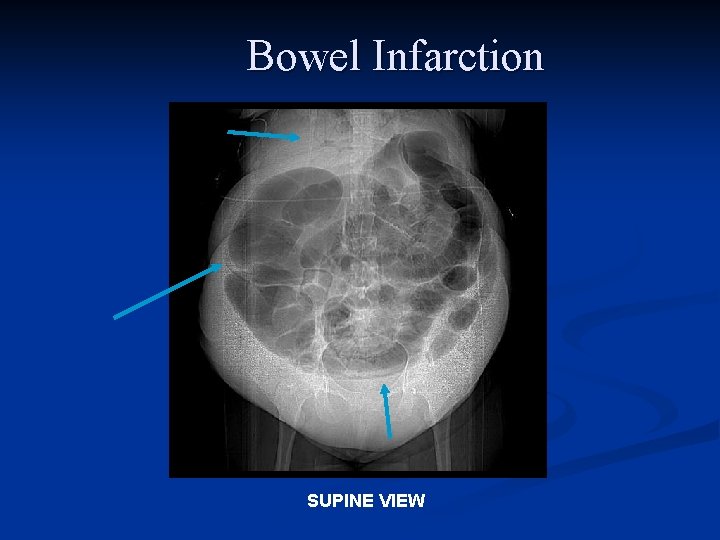 Bowel Infarction SUPINE VIEW 