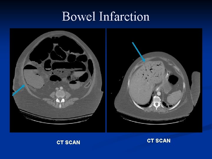 Bowel Infarction CT SCAN 