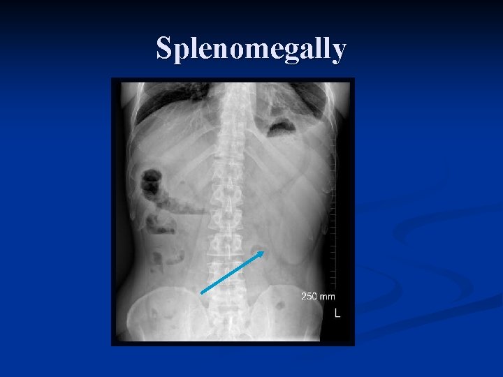 Splenomegally 
