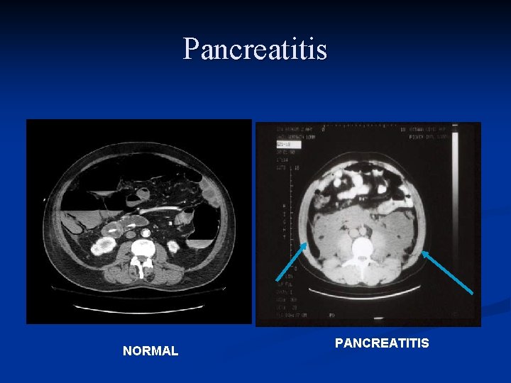Pancreatitis NORMAL PANCREATITIS 