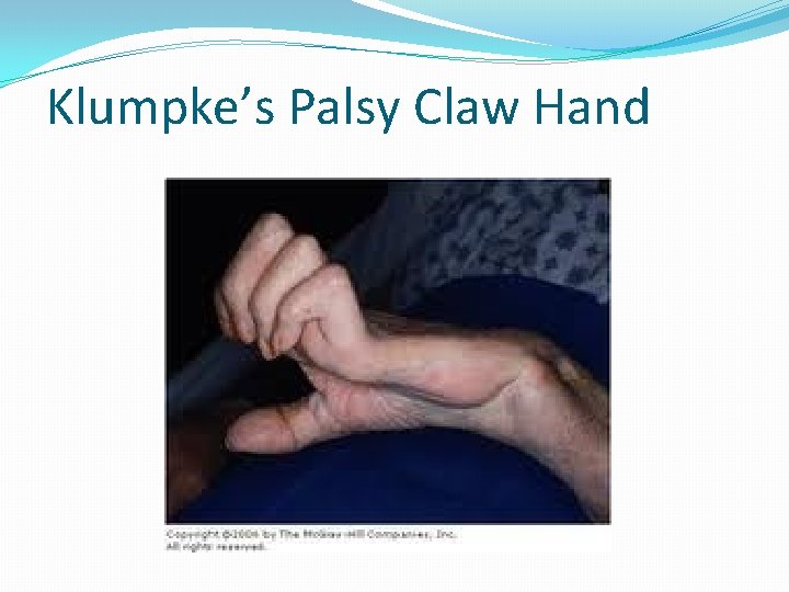 Klumpke’s Palsy Claw Hand 