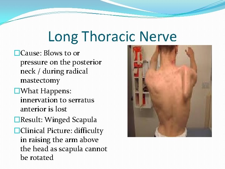 Long Thoracic Nerve �Cause: Blows to or pressure on the posterior neck / during