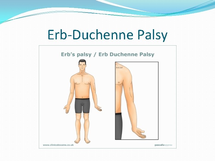 Erb-Duchenne Palsy 