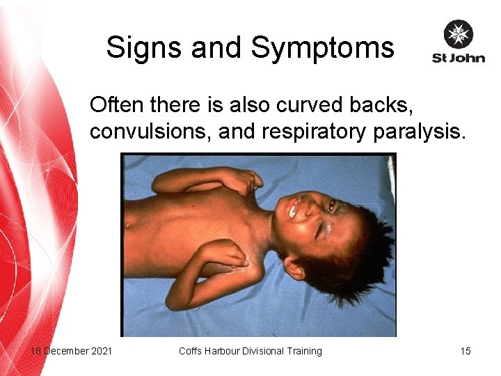 Signs and Symptoms Often there is also curved backs, convulsions, and respiratory paralysis. 18