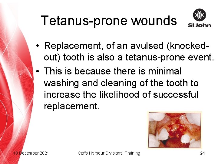 Tetanus-prone wounds • Replacement, of an avulsed (knockedout) tooth is also a tetanus-prone event.