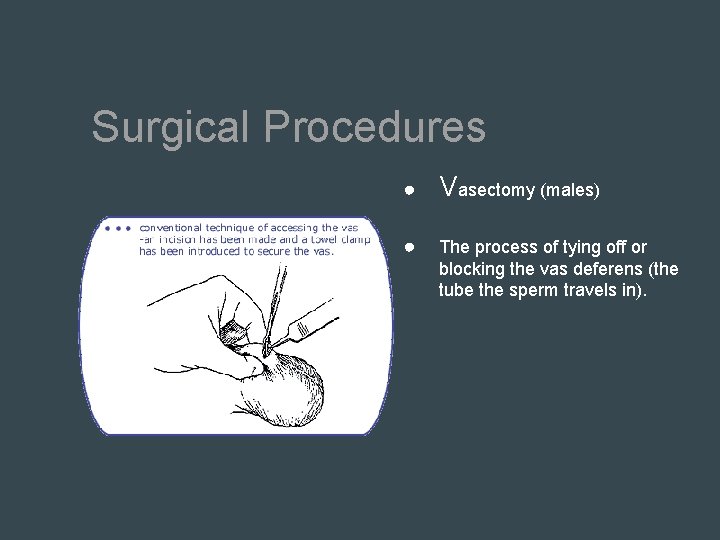 Surgical Procedures ● Vasectomy (males) ● The process of tying off or blocking the