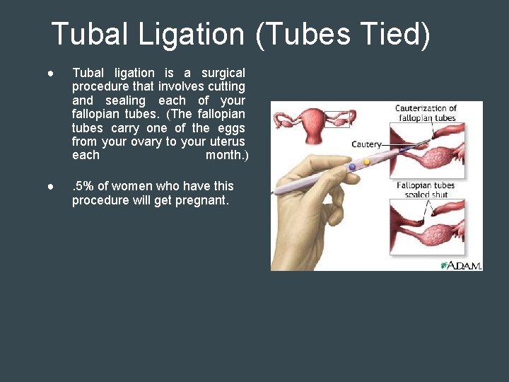 Tubal Ligation (Tubes Tied) ● Tubal ligation is a surgical procedure that involves cutting