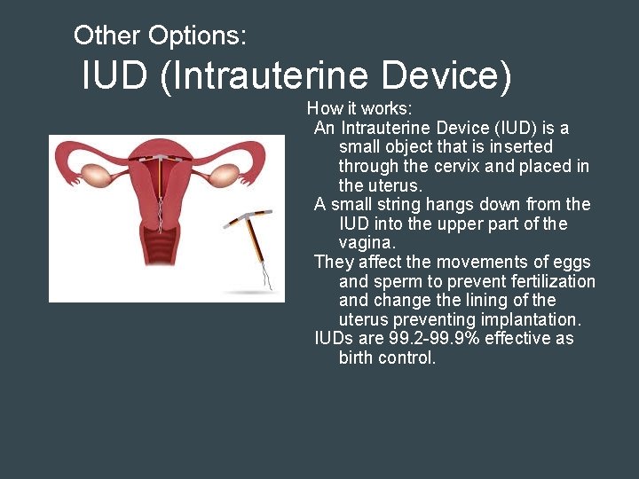 Other Options: IUD (Intrauterine Device) How it works: An Intrauterine Device (IUD) is a