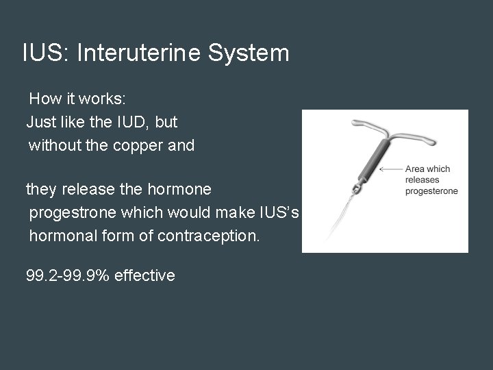 IUS: Interuterine System How it works: Just like the IUD, but without the copper