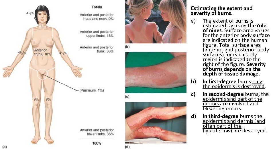 Estimating the extent and severity of burns. a) The extent of burns is estimated