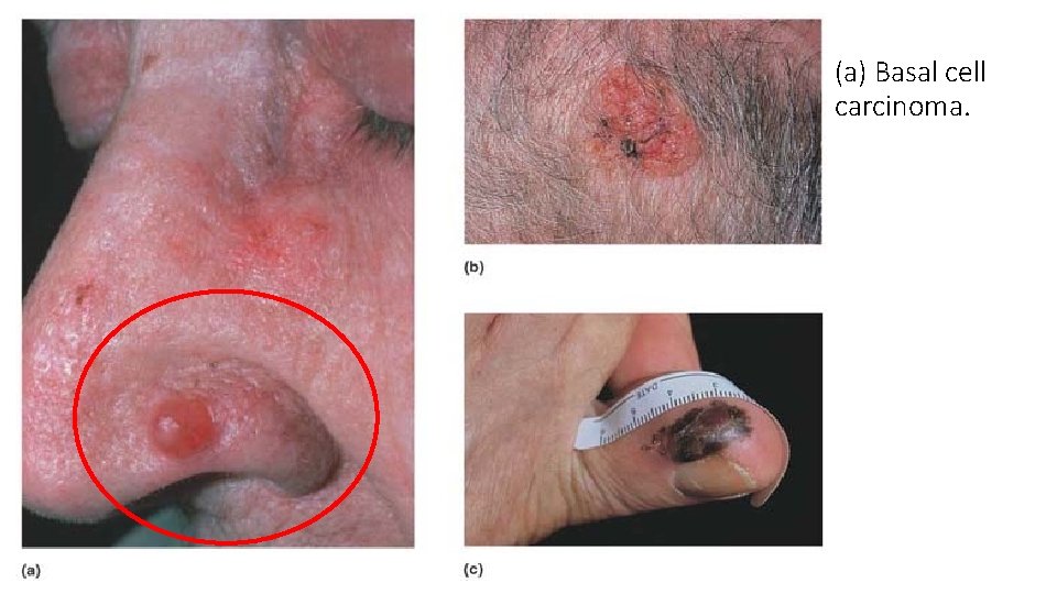 (a) Basal cell carcinoma. 