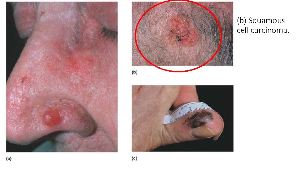 (b) Squamous cell carcinoma. 