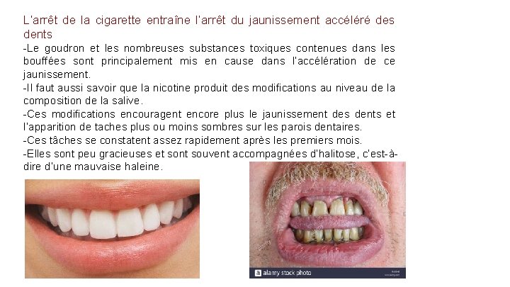 L’arrêt de la cigarette entraîne l’arrêt du jaunissement accéléré des dents -Le goudron et