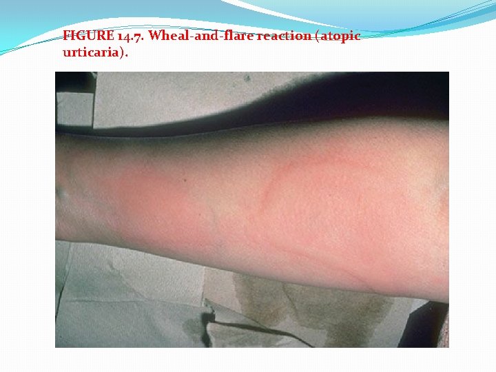 FIGURE 14. 7. Wheal-and-flare reaction (atopic urticaria). 
