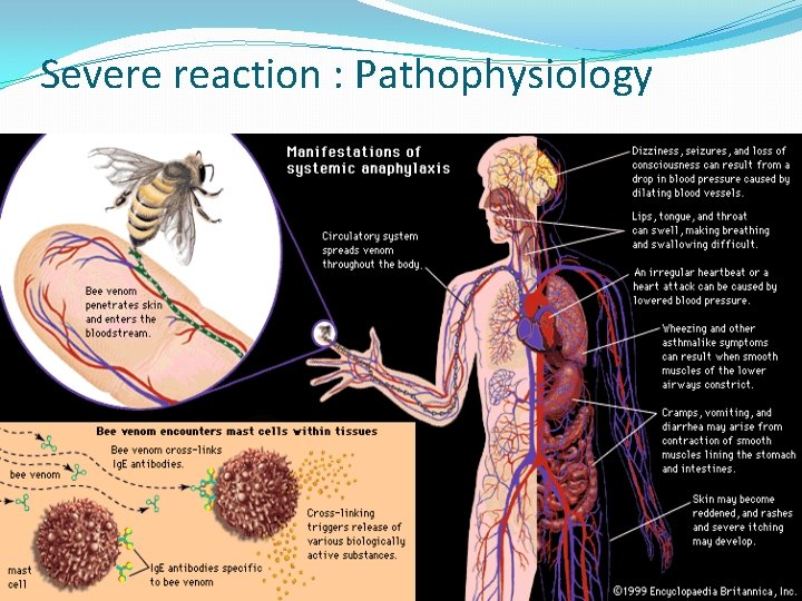 Severe reaction : Pathophysiology 