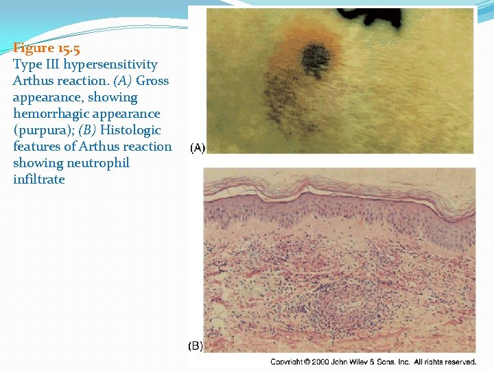Figure 15. 5 Type III hypersensitivity Arthus reaction. (A) Gross appearance, showing hemorrhagic appearance