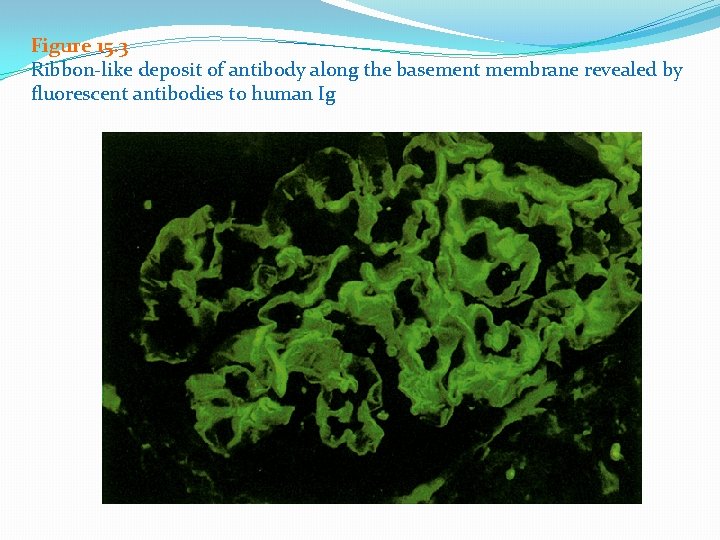 Figure 15. 3 Ribbon-like deposit of antibody along the basement membrane revealed by fluorescent