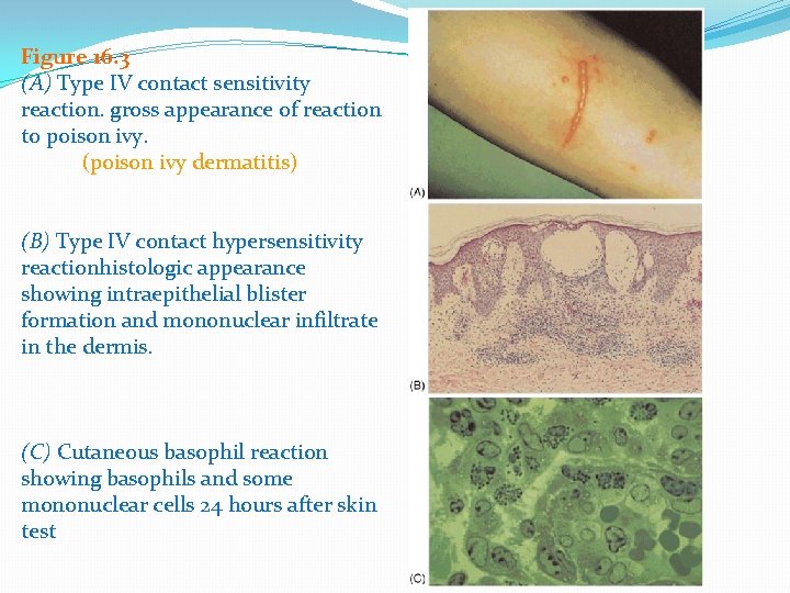 Figure 16. 3 (A) Type IV contact sensitivity reaction. gross appearance of reaction to