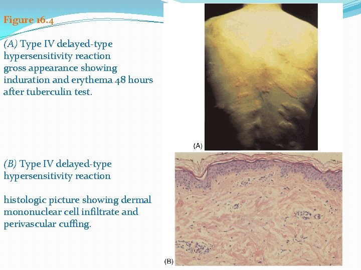 Figure 16. 4 (A) Type IV delayed-type hypersensitivity reaction gross appearance showing induration and