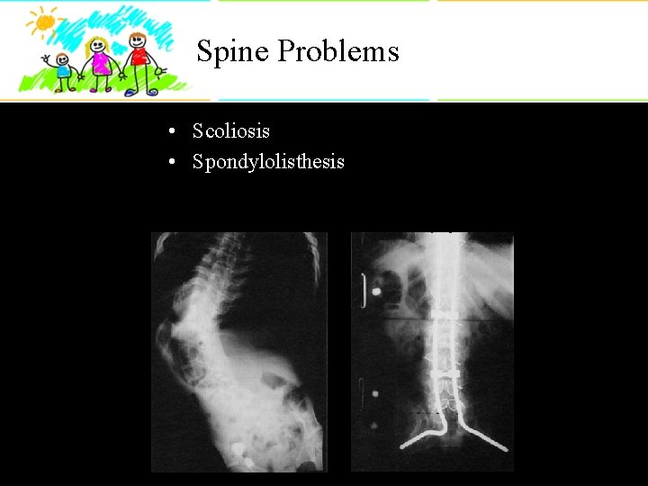 Spine Problems • Scoliosis • Spondylolisthesis 