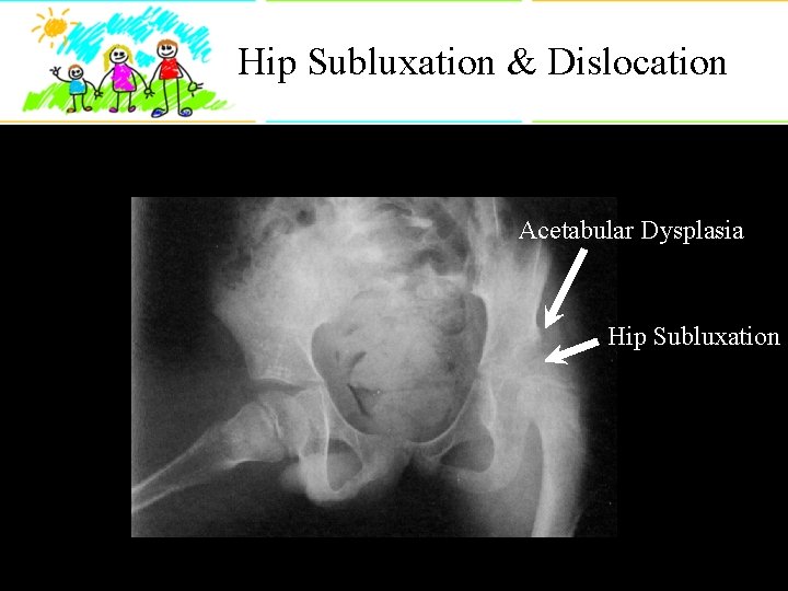 Hip Subluxation & Dislocation Acetabular Dysplasia Hip Subluxation 