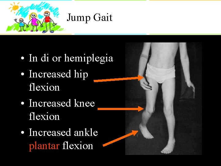 Jump Gait • In di or hemiplegia • Increased hip flexion • Increased knee