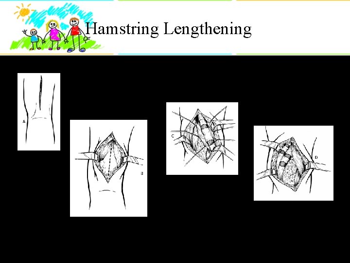 Hamstring Lengthening 