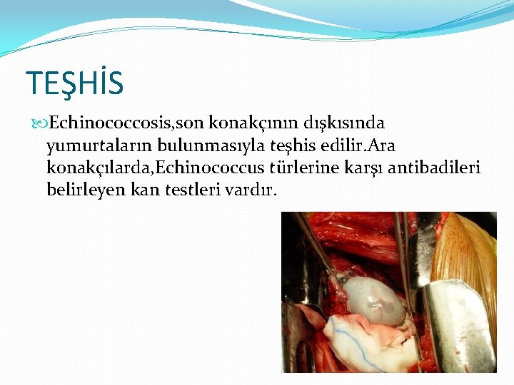 TEŞHİS Echinococcosis, son konakçının dışkısında yumurtaların bulunmasıyla teşhis edilir. Ara konakçılarda, Echinococcus türlerine karşı