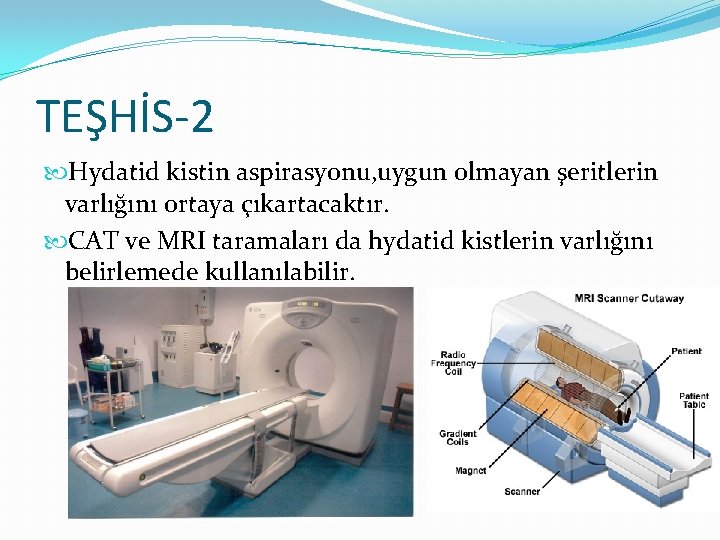 TEŞHİS-2 Hydatid kistin aspirasyonu, uygun olmayan şeritlerin varlığını ortaya çıkartacaktır. CAT ve MRI taramaları