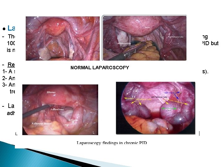 ● Laparoscopy : - The sensitivity of laparoscopy to be as low as 50