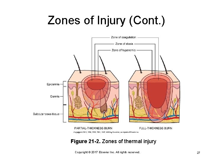 Zones of Injury (Cont. ) Figure 21 -2. Zones of thermal injury Copyright ©