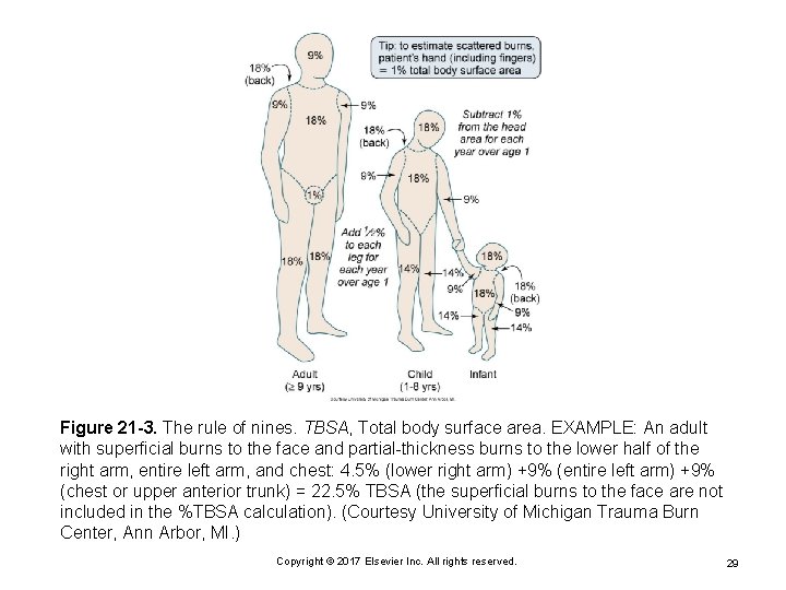 Figure 21 -3. The rule of nines. TBSA, Total body surface area. EXAMPLE: An