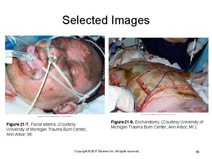 Selected Images Figure 21 -7. Facial edema. (Courtesy University of Michigan Trauma Burn Center,