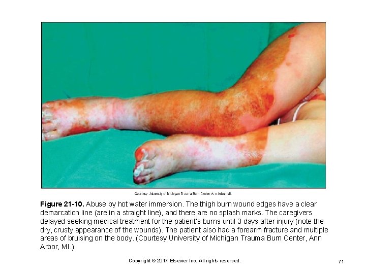 Figure 21 -10. Abuse by hot water immersion. The thigh burn wound edges have