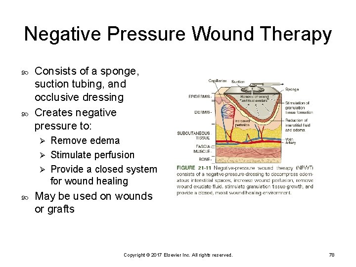 Negative Pressure Wound Therapy Consists of a sponge, suction tubing, and occlusive dressing Creates