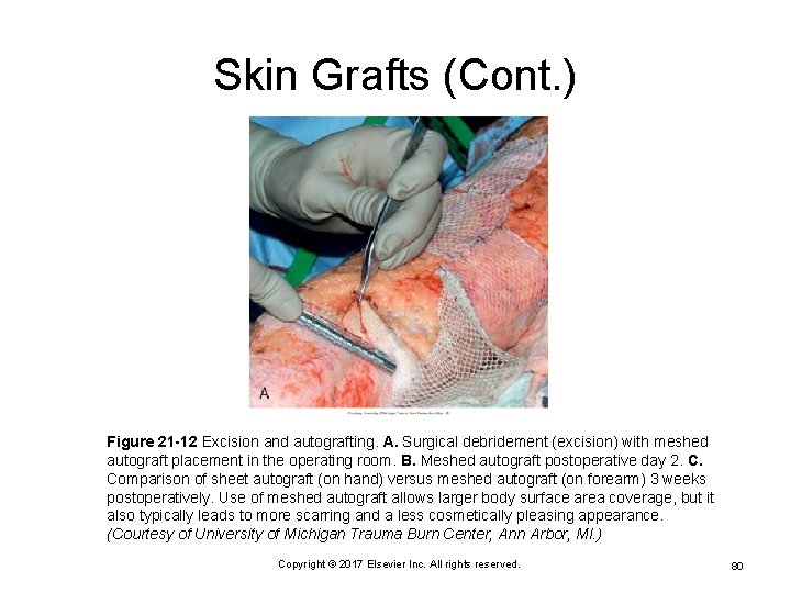 Skin Grafts (Cont. ) Figure 21 -12 Excision and autografting. A. Surgical debridement (excision)