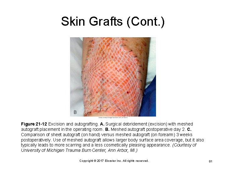 Skin Grafts (Cont. ) Figure 21 -12 Excision and autografting. A. Surgical debridement (excision)