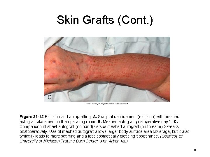Skin Grafts (Cont. ) Figure 21 -12 Excision and autografting. A. Surgical debridement (excision)