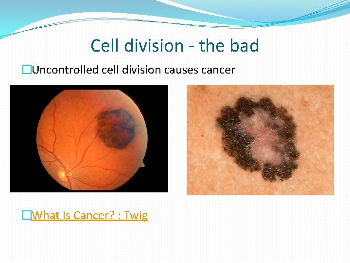 Cell division - the bad �Uncontrolled cell division causes cancer �What Is Cancer? :