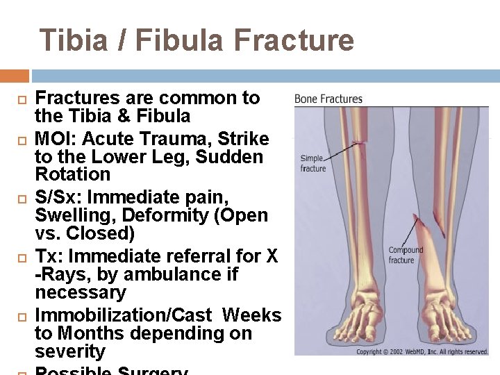 Tibia / Fibula Fracture Fractures are common to the Tibia & Fibula MOI: Acute