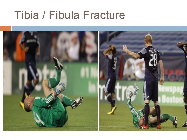 Tibia / Fibula Fracture 