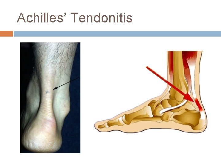 Achilles’ Tendonitis 