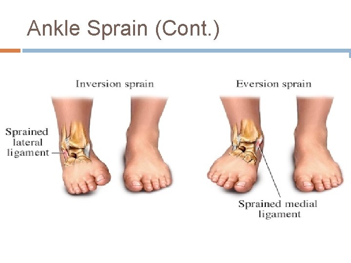 Ankle Sprain (Cont. ) 